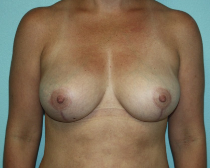 breast-lift-grg-1a