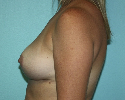 breast-lift-grg-3a